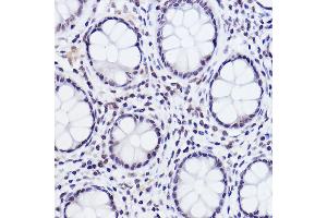 Immunohistochemistry of paraffin-embedded human colon carcinoma using Phospho-c-Jun-S243 Rabbit pAb (ABIN3023576, ABIN3023577, ABIN3023578 and ABIN6225416) at dilution of 1:25 (40x lens). (C-JUN antibody  (pSer243))