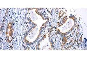 Immunohistochemistry of paraffin-embedded Human gastric cancer using DRD4 Polyclonal Antibody at dilution of 1:30 (DRD4 antibody)
