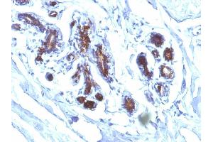 Formalin-fixed, paraffin-embedded human Breast Carcinoma stained with Milk Fat Globule Monoclonal Antibody (EDM45) (MFGE8 antibody)
