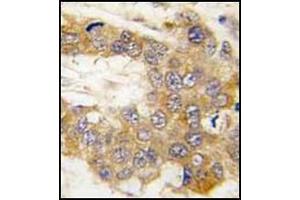 Formalin-Fixed, Paraffin-Embedded human breast carcinoma tissue reacted with Autophagy ATG5 Antibody (N-term) followed which was peroxidase conjugated to the secondary antibody, followed by DAB staining. (ATG5 antibody  (N-Term))