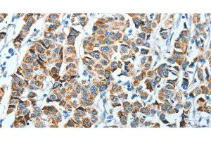 Immunohistochemistry of paraffin-embedded Human breast cancer using ALDH4A1 Polyclonal Antibody at dilution of 1:45 (ALDH4A1 antibody)