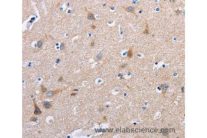 Immunohistochemistry of Human thyroid cancer using FN1 Polyclonal Antibody at dilution of 1:50 (Fibronectin 1 antibody)