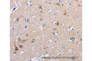Immunohistochemistry of Human thyroid cancer using FN1 Polyclonal Antibody at dilution of 1:50