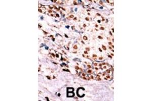 Formalin-fixed and paraffin-embedded human cancer tissue reacted with the primary antibody, which was peroxidase-conjugated to the secondary antibody, followed by AEC staining. (c-MET antibody  (pTyr1349))