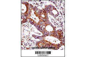 CEACAM7 Antibody immunohistochemistry analysis in formalin fixed and paraffin embedded human colon carcinoma followed by peroxidase conjugation of the secondary antibody and DAB staining. (CEACAM7 antibody  (AA 112-140))