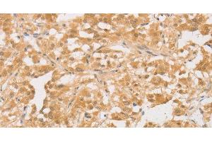 Immunohistochemistry of paraffin-embedded Human thyroid cancer tissue using CD24 Polyclonal Antibody at dilution of 1:40 (CD24 antibody)
