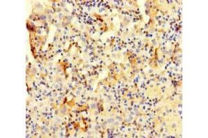 Immunohistochemistry of paraffin-embedded human lung cancer using ABIN7147985 at dilution of 1:100 (COTL1 antibody  (AA 2-142))