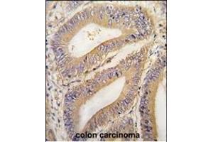 Formalin-fixed and paraffin-embedded human colon carcinoma tissue reacted with PHB2 Antibody (N-term) (ABIN391410 and ABIN2841408) , which was peroxidase-conjugated to the secondary antibody, followed by DAB staining. (Prohibitin 2 antibody  (N-Term))