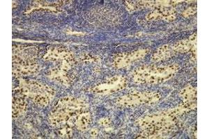 Immunohistochemical staining (Formalin-fixed paraffin-embedded sections) of human lung adenocarcinoma with NKX2-1 monoclonal antibody, clone G21-G . (NKX2-1 antibody  (N-Term))