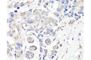 Immunohistochemistry of paraffin-embedded Human breast cancer using BAP1 Polyclonal Antibody at dilution of 1:150 (40x lens).