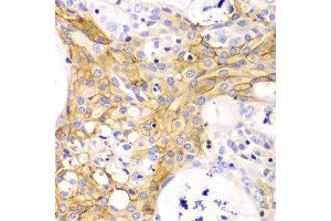 Immunohistochemistry of paraffin-embedded human oophoroma using ACTA2 antibody at dilution of 1:100 (400x lens). (Smooth Muscle Actin antibody)