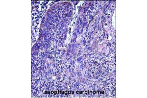 P3 Antibody (N-term)  iunohistochemistry analysis in formalin fixed and paraffin embedded human esophagus carcinoma followed by peroxidase conjugation of the secondary antibody and DAB staining. (MMP3 antibody  (N-Term))