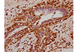 IHC image of ABIN7145515 diluted at 1:200 and staining in paraffin-embedded human breast cancer performed on a Leica BondTM system. (Klotho beta antibody  (AA 1-130))
