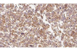 ABIN6278484 at 1/100 staining Human Melanoma tissue by IHC-P. (INHBC antibody  (C-Term))