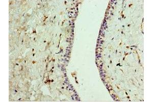 Immunohistochemistry of paraffin-embedded human breast cancer using ABIN7167823 at dilution of 1:100 (GPRC5A antibody  (AA 258-357))