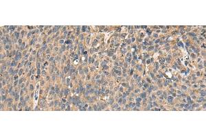 Immunohistochemistry of paraffin-embedded Human cervical cancer tissue using MRPL42 Polyclonal Antibody at dilution of 1:65(x200) (MRPL42 antibody)