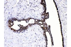 IHC testing of FFPE human breast cancer tissue with CASP8 antibody at 1ug/ml. (Caspase 8 antibody  (AA 410-449))