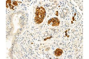 ABIN6263468 and ABIN6272966 at 1/100 staining Human pancreatic cancer by IHC-P.
