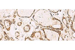 Immunohistochemistry of paraffin-embedded Human thyroid cancer tissue using ATP5O Polyclonal Antibody at dilution of 1:90(x200) (ATP5O antibody)