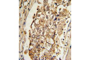 Formalin-fixed and paraffin-embedded human breast carcinoma with MCL1 Antibody (BH3 Domain Specific), which was peroxidase-conjugated to the secondary antibody, followed by DAB staining. (MCL-1 antibody  (AA 191-226))