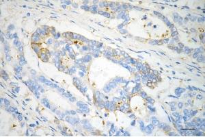 Immunohistochemistry was performed on paraffin-embedded human sigmoid colon carcinoma using PKC alpha antibody (ABIN7799991), 1:200).