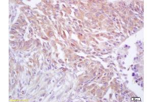Formalin-fixed and paraffin embedded human lung carcinoma labeled with Rabbit Anti CDC37 Polyclonal Antibody, Unconjugated (ABIN706481) at 1:200 followed by conjugation to the secondary antibody and DAB staining (CDC37 antibody  (AA 291-378))