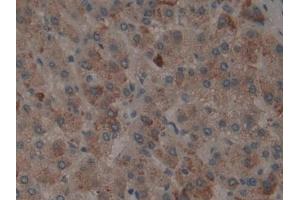 Detection of tPA in Human Liver cancer Tissue using Polyclonal Antibody to Tissue Plasminogen Activator (tPA) (PLAT antibody)