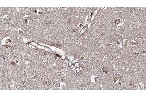 ABIN6277506 at 1/100 staining Human brain cancer tissue by IHC-P.