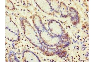 Immunohistochemistry of paraffin-embedded human gastric cancer using ABIN7160637 at dilution of 1:100 (SET Binding Factor 2 antibody  (AA 1585-1813))