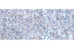 Immunohistochemistry of paraffin-embedded Human liver cancer tissue using ZIC1 Polyclonal Antibody at dilution of 1:65(x200) (ZIC1 antibody)