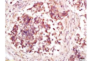 Formalin-fixed and paraffin embedded human lung carcinoma labeled with Anti-Phospho-MDM2(Thr218) Polyclonal Antibody, Unconjugated (ABIN802533) at 1:200 followed by conjugation to the secondary antibody and DAB staining