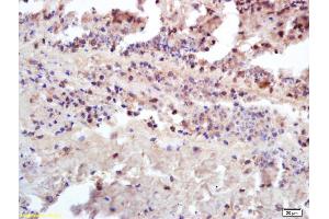 Formalin-fixed and paraffin embedded human kidney carcinoma labeled with Anti-Insulin receptor subunit beta/INSR/CD220 Polyclonal Antibody, Unconjugated (ABIN1714205) at 1:200 followed by conjugation to the secondary antibody and DAB staining (ISR-beta antibody  (AA 801-900))