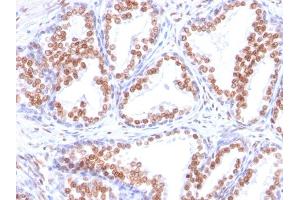 Formalin-fixed, paraffin-embedded human Prostate Carcinoma stained with Androgen Receptor Mouse Monoclonal Antibody (DHTR/882). (Androgen Receptor antibody  (AA 151-350))