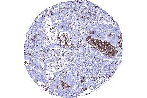 Colon Colorectal adenocarcinoma showing numerous S100A12 positive granulocytes in the stroma and within tumor glands (S100A12 antibody)