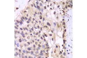 Immunohistochemistry of paraffin-embedded human lung cancer using PSMA6 antibody. (PSMA6 antibody)