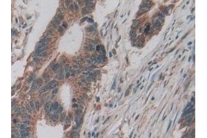 Detection of LTbR in Human Colorectal cancer Tissue using Polyclonal Antibody to Lymphotoxin Beta Receptor (LTbR) (LTBR antibody  (AA 66-215))