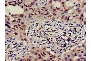 Immunohistochemistry of paraffin-embedded human lung cancer using ABIN7145371 at dilution of 1:100 (B3GALT4 antibody  (AA 42-266))