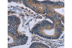 Immunohistochemistry of Human colon cancer using IPO4 Polyclonal Antibody at dilution of 1:50 (Importin 4 antibody)