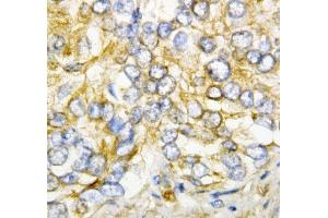 IHC-P: AIMP2 antibody testing of human rectal cancer tissue (AIMP2 antibody  (AA 298-320))