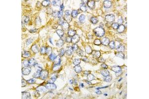 IHC-P: AIMP2 antibody testing of human rectal cancer tissue