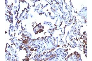 Formalin-fixed, paraffin-embedded human Melanoma metastasized to Lung stained with CD63 Monoclonal Antibody (NKI/C3 + LAMP3/968) (CD63 antibody)