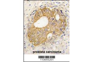 Formalin-fixed and paraffin-embedded human prostata carcinoma tissue reacted with CDH3 antibody , which was peroxidase-conjugated to the secondary antibody, followed by DAB staining. (P-Cadherin antibody  (N-Term))