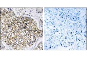 Immunohistochemistry analysis of paraffin-embedded human breast carcinoma tissue, using LPHN2 Antibody. (LPHN2 antibody  (AA 551-600))