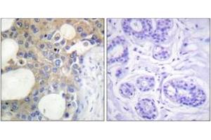 Immunohistochemistry analysis of paraffin-embedded human breast carcinoma tissue, using CD227/MUC1 (Ab-1229) Antibody. (MUC1 antibody  (AA 1201-1250))