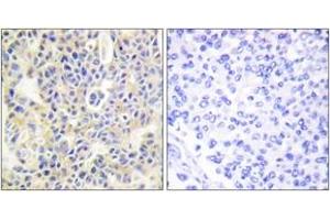 Immunohistochemistry analysis of paraffin-embedded human breast carcinoma, using PKC thet (Phospho-Ser695) Antibody. (PKC theta antibody  (pSer695))