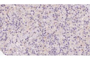 ABIN6273122 at 1/100 staining Human lymph cancer tissue by IHC-P. (HERPUD1 antibody  (N-Term))