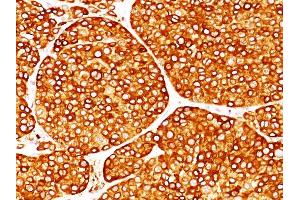 Formalin-fixed, paraffin-embedded melanoma (20X) stained with Tyrosinase Monoclonal Antibody (T311). (TYR antibody)