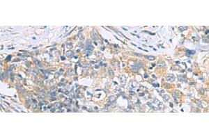 Immunohistochemistry of paraffin-embedded Human esophagus cancer tissue using PPIC Polyclonal Antibody at dilution of 1:50(x200) (PPIC antibody)