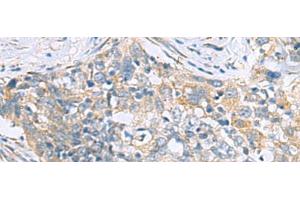 Immunohistochemistry of paraffin-embedded Human esophagus cancer tissue using PPIC Polyclonal Antibody at dilution of 1:50(x200) (PPIC antibody)