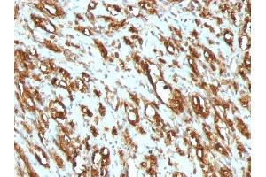 Formalin-fixed, paraffin-embedded human Rhabdomyosarcoma stained with Muscle Specific Actin Mouse Monoclonal Antibody (MSA/953).